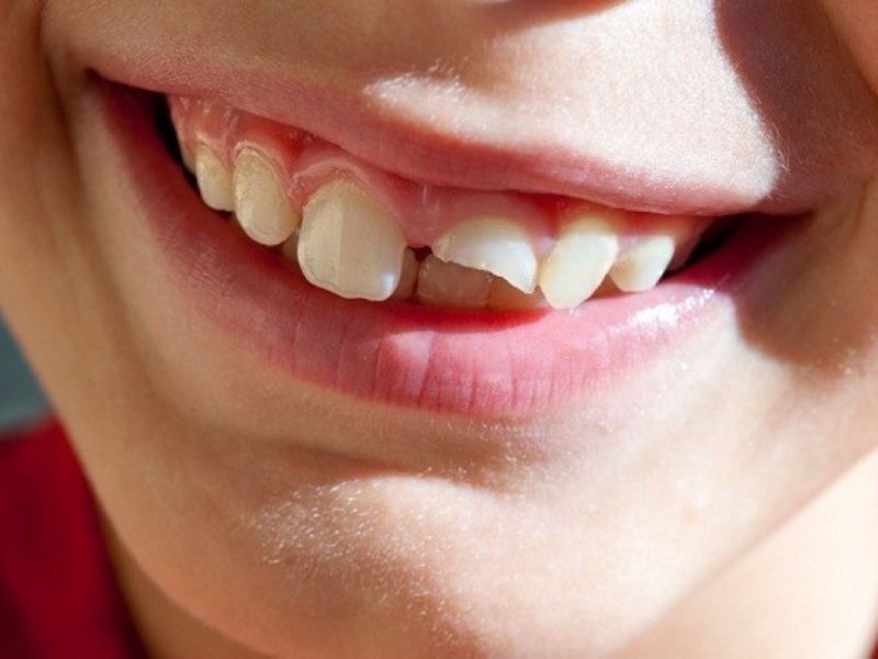 Mơ thấy răng bị gãy thường là dấu hiệu của sự lo lắng