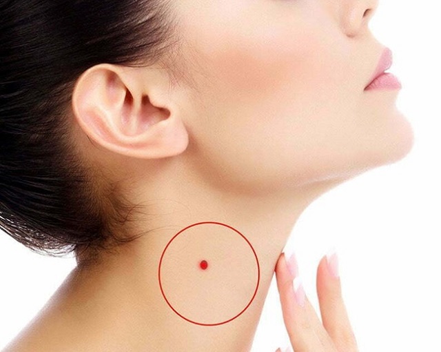 Cần cân nhắc kỹ trước khi xóa nốt ruồi son