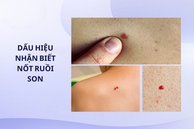 Nốt ruồi màu đỏ xuất hiện trên bề mặt da