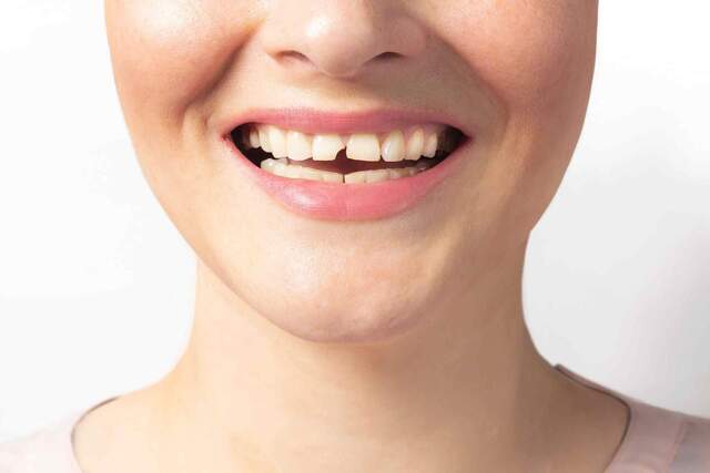 Răng cửa nằm ở vị trí trung tâm và là đại diện cho sự tự tin, bộ mặt bên ngoài cũng như các mối quan hệ xung quanh Răng cửa nằm ở vị trí trung tâm và là đại diện cho sự tự tin, bộ mặt bên ngoài cũng như các mối quan hệ xung quanh